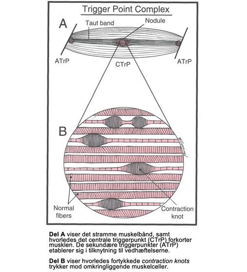Slide: Triggerpunktets fysiologi